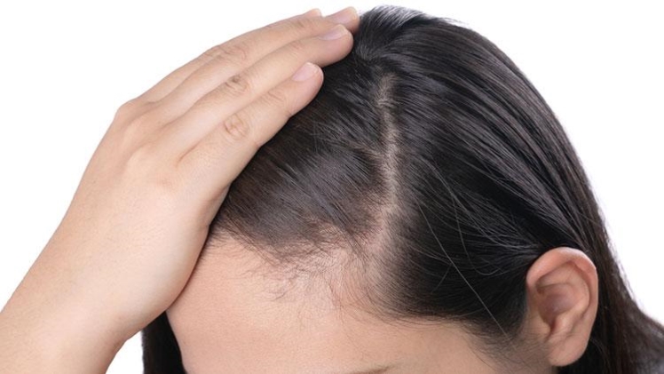 How to Reverse DHEA Hair Loss